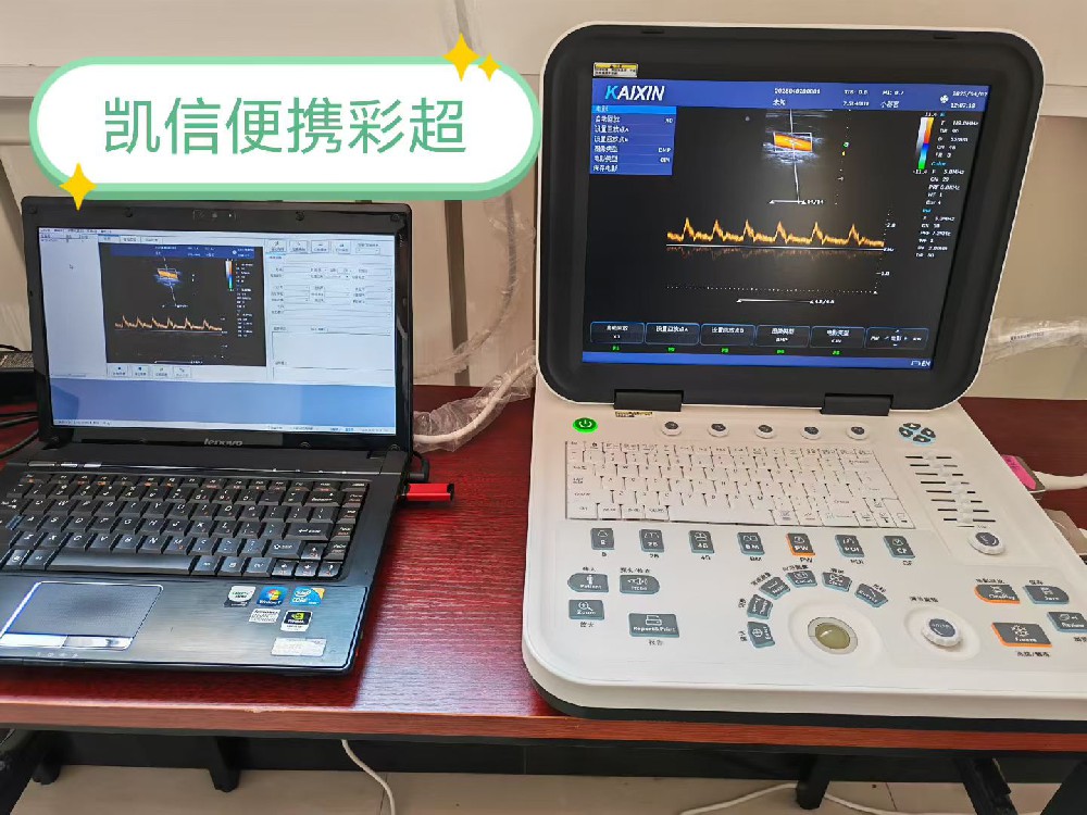 急性胆囊炎的超声检查