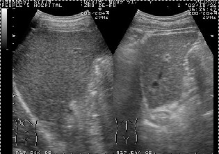 彩超机检查下的正常肝脏B超声像图